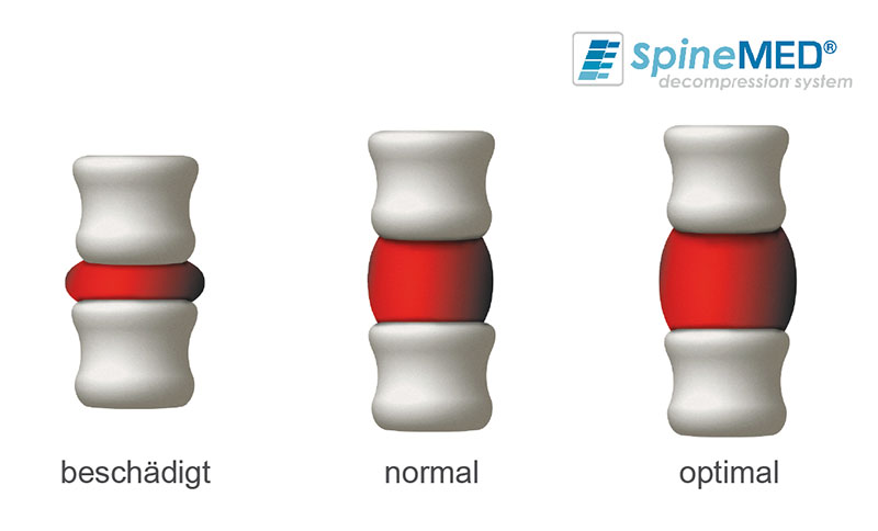 SpineMED Wirkprinzip